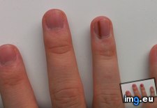 Tags: colors, developed, finger, formed, nail, ring, skin (Pict. in My r/MILDLYINTERESTING favs)