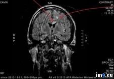 Tags: brain, chance, compiled, eat, for, injury, months, recovery, survived, talk, traumatic, walk (Pict. in My r/PICS favs)