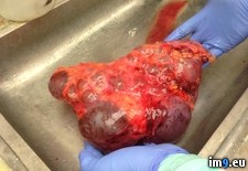 Tags: brave, disease, dissecting, for, human, kidney, polycystic, popping, video, wtf (Pict. in My r/WTF favs)