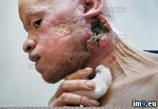 Tags: albino, cancer, man, skin, untreated, wtf (Pict. in My r/WTF favs)
