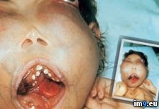 Tags: case, cherubism, disorder, facial, genetic, rare, severe, swelling, wtf (Pict. in My r/WTF favs)