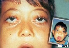 Tags: case, cherubism, disorder, facial, genetic, rare, severe, swelling, wtf (Pict. in My r/WTF favs)