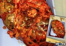 Tags: due, kidneys, one, pkd, removed, ruler, scale, wtf (Pict. in My r/WTF favs)