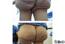 Tags: butt, huge, implants, legs, skinny, wtf (Pict. in My r/WTF favs)