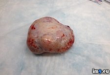 Tags: asked, delivered, ovarian, picture, ruler, scale, surgeon, wtf (Pict. in My r/WTF favs)
