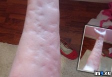 Tags: arm, caused, cold, degree, hives, rainy, run, urticaria, weather, wtf (Pict. in My r/WTF favs)