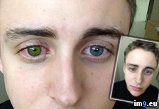 Tags: changed, eyes, friend, green, info, keratoconus, one, surgery, wtf (Pict. in My r/WTF favs)