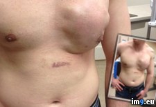 Tags: couple, friend, gynecomastia, hard, sneezed, surgery, weeks, wtf (Pict. in My r/WTF favs)