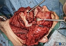 Tags: cancer, oral, surgery, wtf (Pict. in My r/WTF favs)