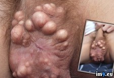 Tags: cyst, multiple, sac, sebaceous, testicles, wtf (Pict. in My r/WTF favs)