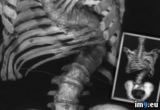 Tags: scoliosis, severe, spine, untreated, wtf (Pict. in My r/WTF favs)