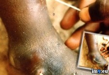 Tags: countries, extracted, guinea, matter, months, parasite, skin, undeveloped, worm, wtf (Pict. in My r/WTF favs)