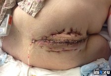 Tags: anus, removal, surgery, wtf (Pict. in My r/WTF favs)