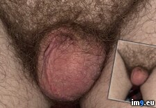 Tags:  (Pict. in Penectomy Joseph Ray Lee)