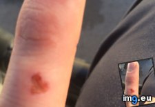 Tags: finger, heart, kind, scab (Pict. in My r/MILDLYINTERESTING favs)