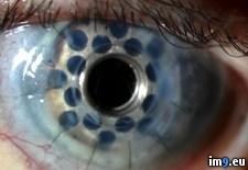 Tags: cornea, prosthetic (Pict. in My r/PICS favs)