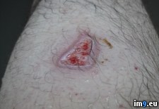 Tags: #wound#