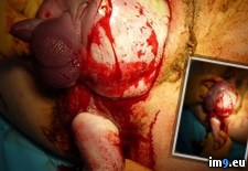 Tags: anus, baby, birth, breech, leg, mother, out, wtf (Pict. in My r/WTF favs)