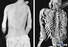 Tags: are, bone, damaged, disease, fibrodysplasia, ossificans, progressiva, regrow, slowly, soft, sufferers, tissue, wtf (Pict. in My r/WTF favs)