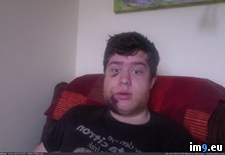 Tags: corrective, had, happened, jaw, surgery, swelling, wtf (Pict. in My r/WTF favs)