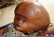 Tags: hydrocephalus, wtf (Pict. in My r/WTF favs)