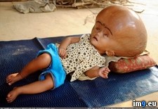 Tags: hydrocephalus, wtf (Pict. in My r/WTF favs)