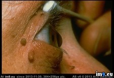 Tags: bill, cosby, disease, eye, keratoconus, suffers, wtf (Pict. in My r/WTF favs)