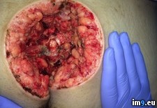 Tags: butt, cousin, cyst, removed, tender, wtf (Pict. in My r/WTF favs)