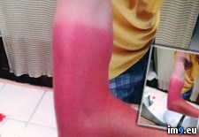 Tags: day, friend, long, sunburn, wtf (Pict. in My r/WTF favs)