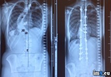 Tags: rays, scoliosis, treatment, wtf (Pict. in My r/WTF favs)