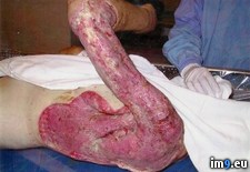 Tags: bad, batch, disease, eating, fasciitis, flesh, friend, heroin, infected, mother, necrotizing, smuggled, was, wtf (Pict. in My r/WTF favs)