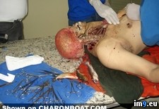 Tags: accident, aftermath, cut, nsfl, wtf (Pict. in My r/WTF favs)