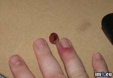 Tags: granuloma, pyogenic, wtf (Pict. in My r/WTF favs)