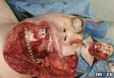 Tags: cancer, oral, surgery, wtf (Pict. in My r/WTF favs)