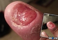 Tags: ago, fingernail, off, regrowth, ripped, wtf (Pict. in My r/WTF favs)
