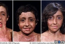 Tags: burned, child, heartwarming, oddly, results, severely, surgeries, wtf (Pict. in My r/WTF favs)