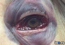 Tags: black, eye, wtf (Pict. in My r/WTF favs)