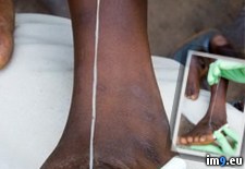 Tags: guinea, worm, wtf (Pict. in My r/WTF favs)